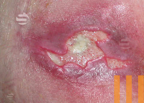 Decubitus categorie III