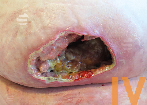 Decubitus categorie IV