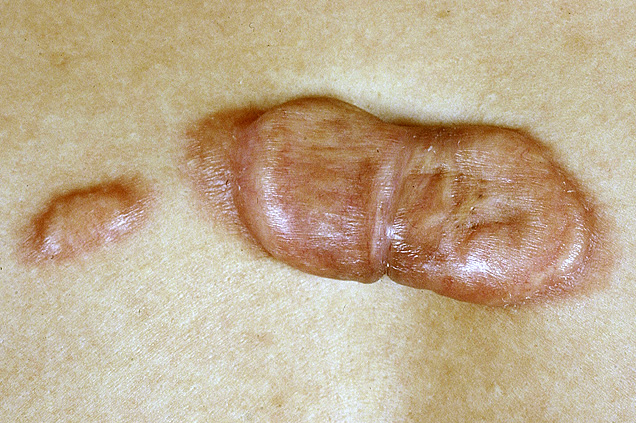 Keloid litteken