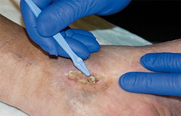 Scherp debridement curette