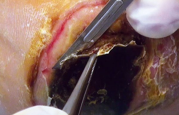 Scherp debridement mes