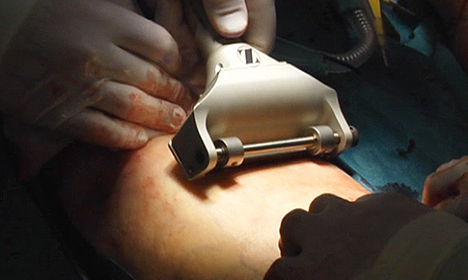 Een dun laagje huid wordt er van het bovenbeen gehaald.