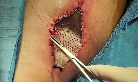 Skin Split graft