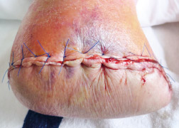 WL Amputatie bovenbeen