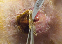 WL Debridement