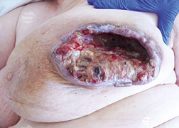 WL Oncologische ulcus