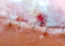 WL Postoperatieve wondinfectie